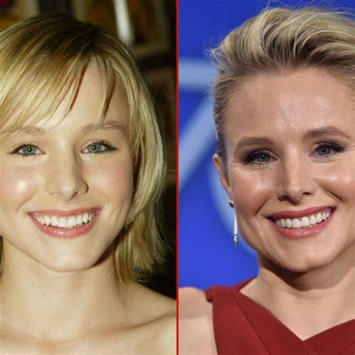 Celebrity Kristen Bell Nose Job