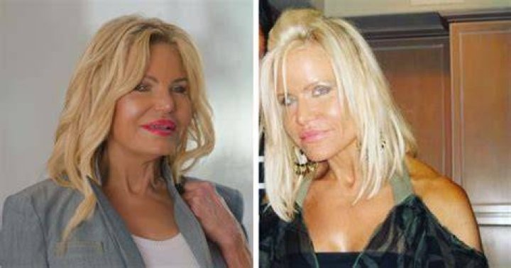 Gio Helou Mom Plastic Surgery: A Journey Of Transformation